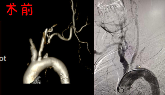 一医好技术|脉搏为何莫名消失？介入微创术让老人脉动“失而复得”